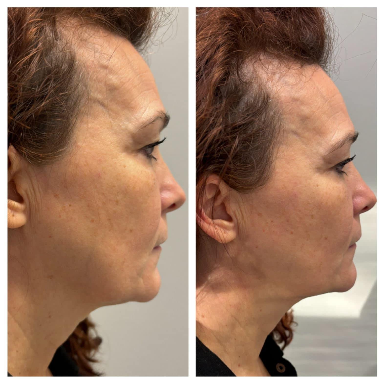 Liftera HIFU behandeling - Voor en na
